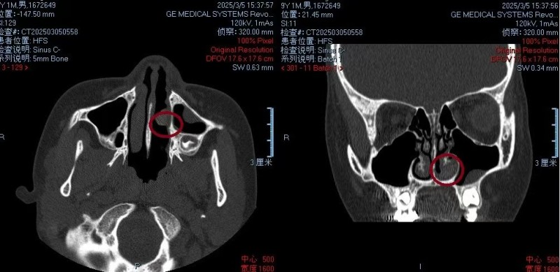 9 岁男童鼻腔藏橡皮一年，医生精准施治成功取出